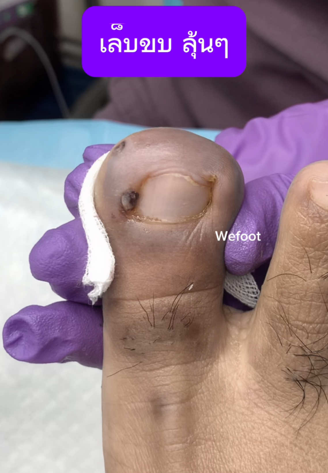 เล็บขบบบ แบบนี้มาลุ้นกันคะ#ingrowntoenail #wefootตัดเล็บขบรักษาเล็บเชื้อรา #เล็บขบหนักมาก #ตัดเล็บขบมียาชา #เล็บขบ #ตัดเล็บขบ #เล็บขบอักเสบ 