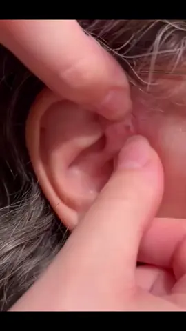 Popping A Blackhead On My Moms Ear #pimples #fy #fyp #pimple #satisfying #pop 