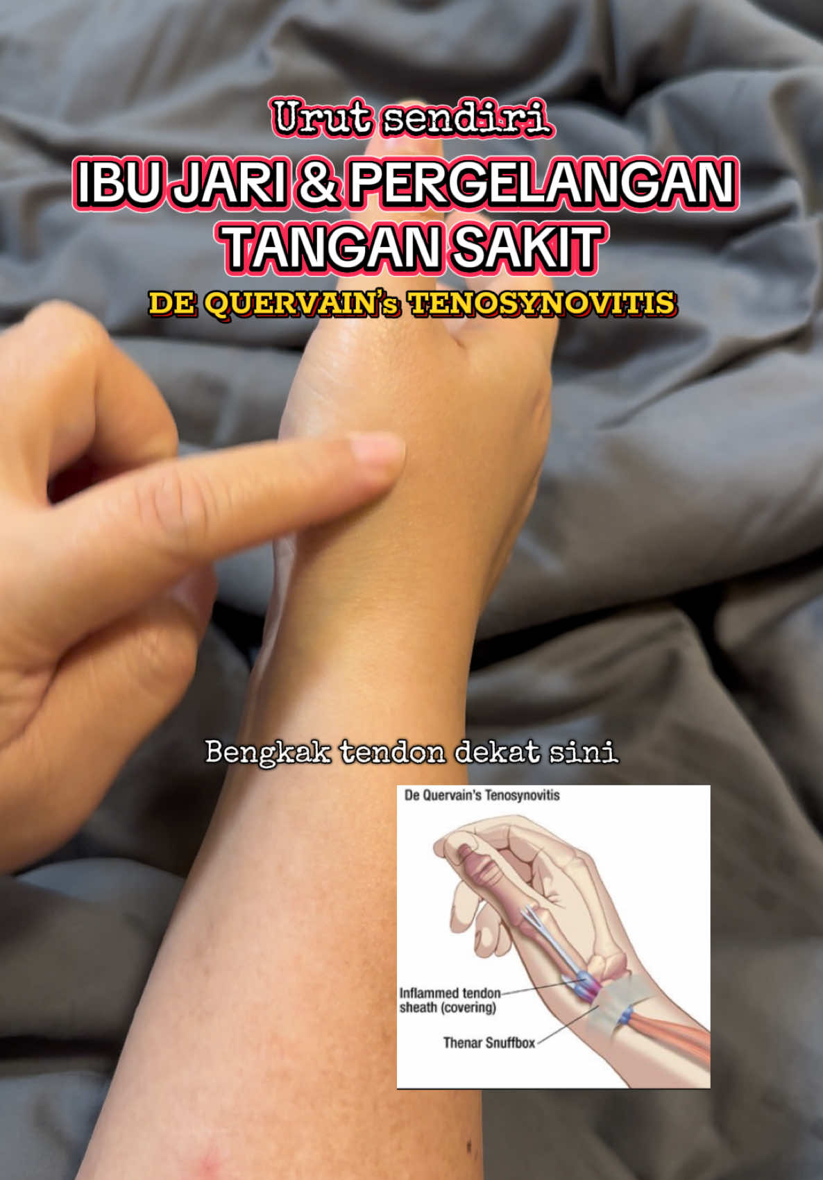 Sakit ibu jari ni boleh jadi sekejap dan boleh jadi sakit berpanjangan. Mana tahan, urut la sendiri boleh lega byk sakitnya. Jgn lupa rehatkan jari tu. #dequervainstenosynovitis #jempol #thumb #wristpain #tendon #asrichzspa 