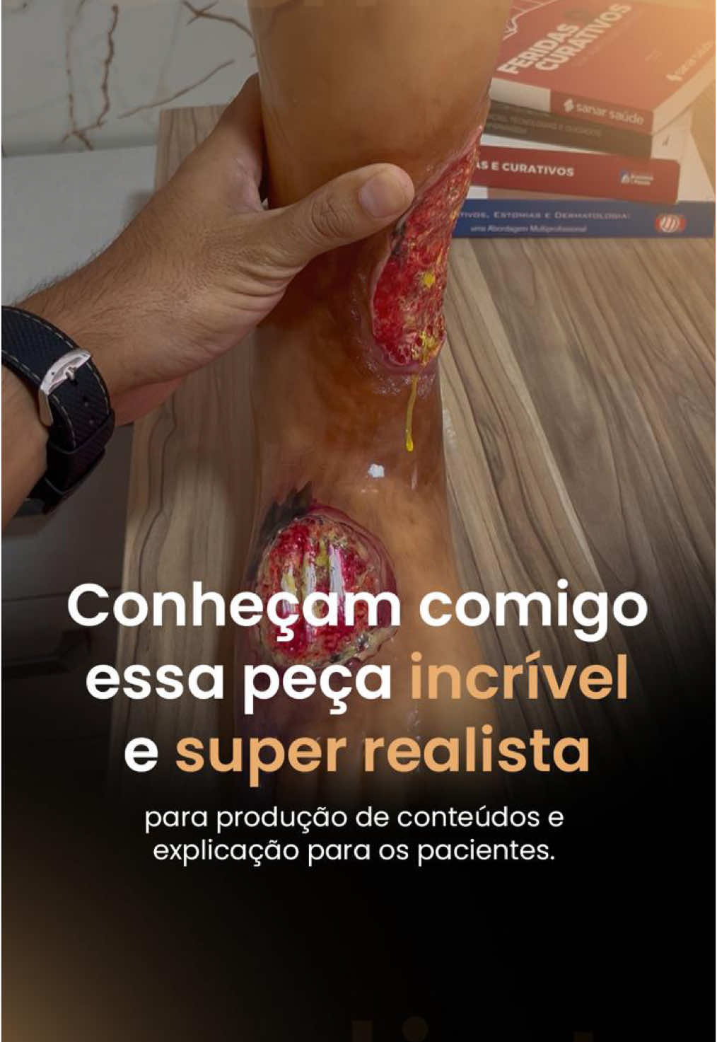 Apaixonado demais nessa peça realística que simula uma perna com úlcera vasculogênica e outras feridas. E você, o que achou? 