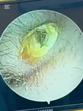 #ឈឺត្រចៀក #ឈឺច្រមុះ #ឈឺបំពង់ក @Dr SEAN SAN official❤❤❤❤ 