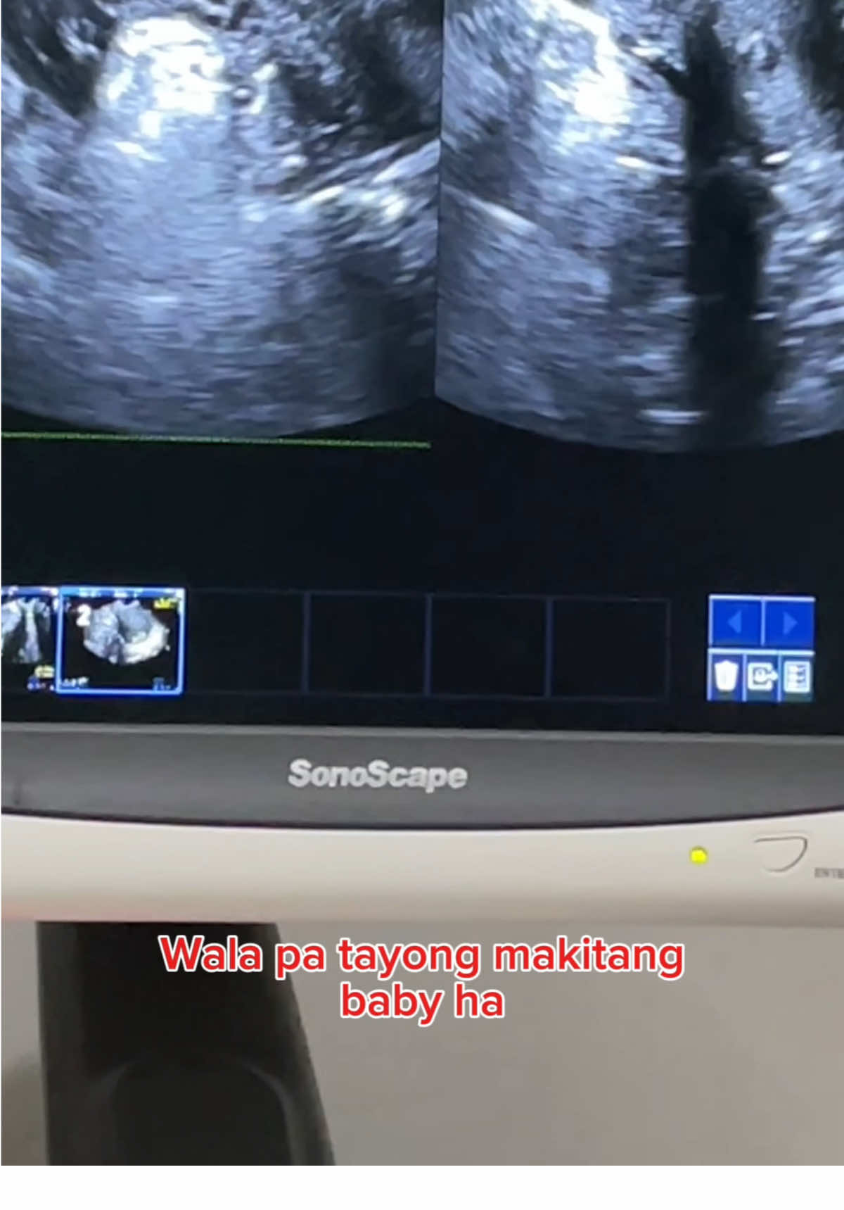 Replying to @Angie Walang nakitang baby nung unang ultrasound. Pero wag agad kabahan mga mommy kapag ganyan since maliit pa si baby at posible na hindi pa makita sa utz. #pregnant #pregnancy #twins #pcos #identicaltwins 