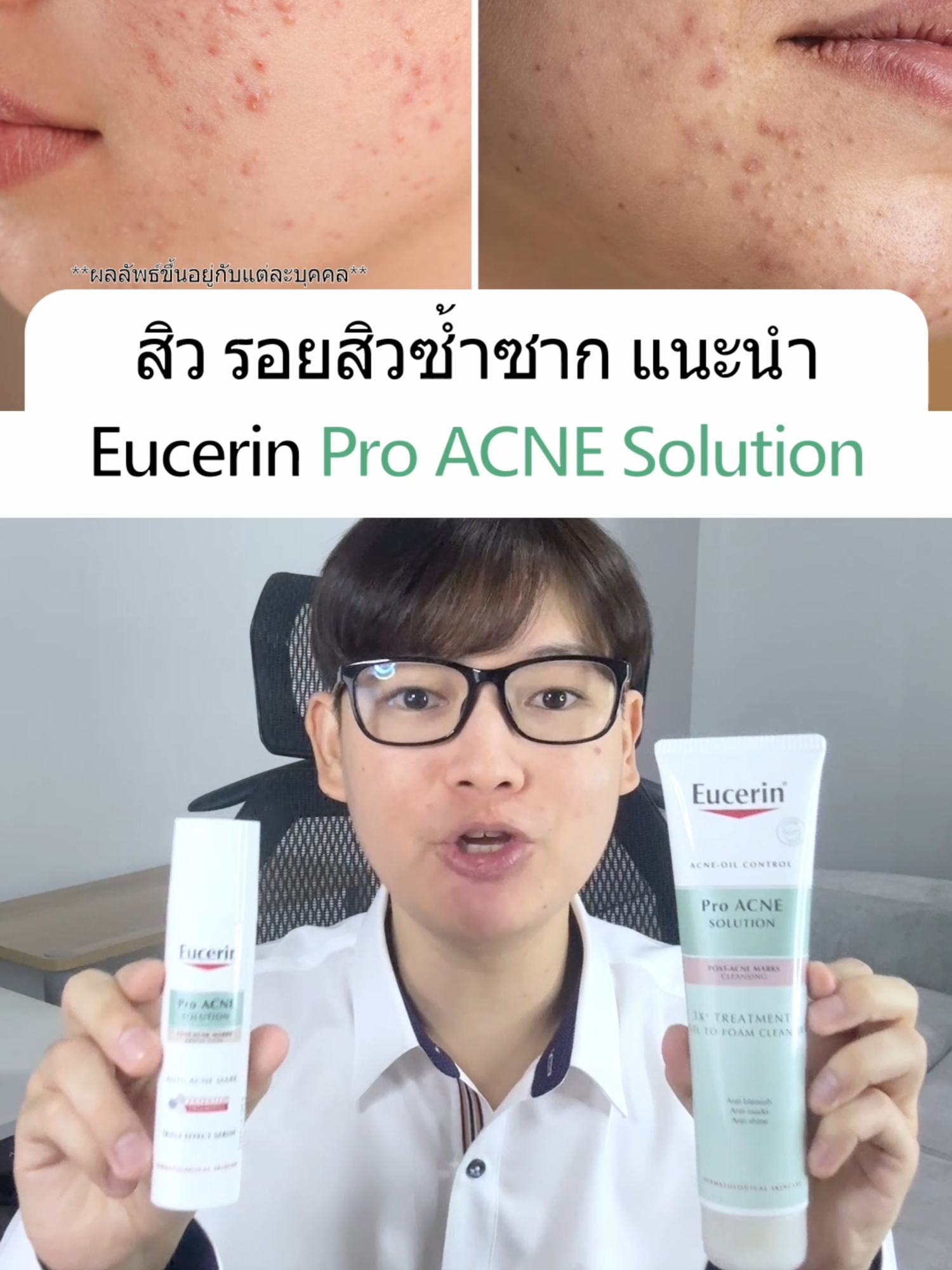 จบทุกสิว รอยสิวซ้ำซาก ด้วย Eucerin เริ่มเห็นผลตั้งแต่ครั้งแรกที่ใช้ #EucerinThailand #จบทุกสิวและรอยสิวซ้ำซาก #EucerinTripleEffectSerum #EucerinGeltoFoam #รักษาสิว #khonchon