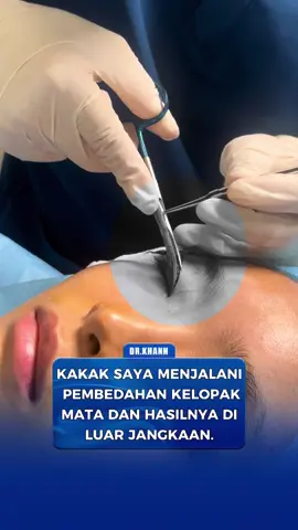 Kakak saya menjalani pembedahan kelopak mata dan hasilnya di luar jangkaan. #fyp #malaysia #drkhanh #eyelid #doubleeyelid #combo 