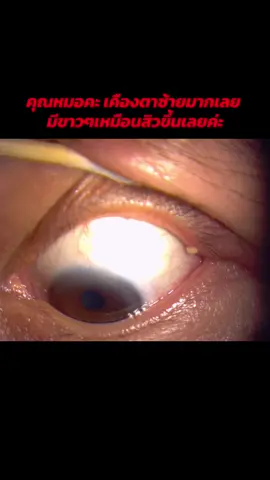 สิวขึ้นที่เปลือกตา!!? #ต่อมไขมันเปลือกตาอุดตัน #MGD #ตากุ้งยิง #hordeolum #คลินิกตาหมอวิว #จักษุแพทย์ #คลินิกตาสุพรรณบุรี #สปาเปลือกตา  