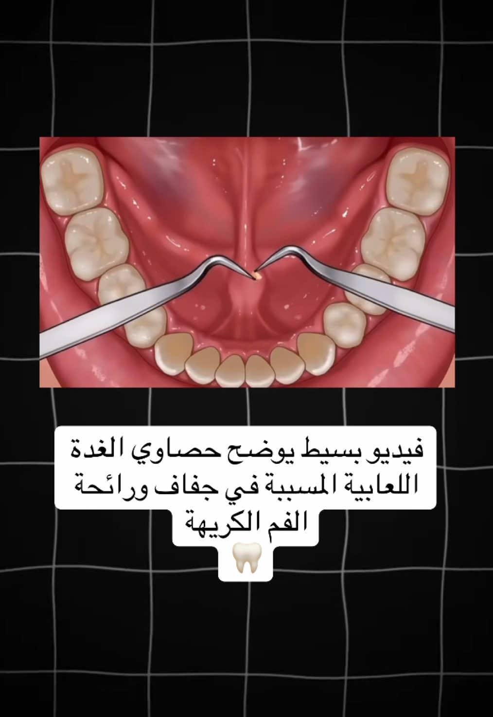 #طب_اسنان #طب_الاسنان #الغدة_اللعابية #حصاوي_الغدة_اللعابية #حصوة_الغدة_اللعابية #رائحة_الفم_الكريهة #salivarystone 