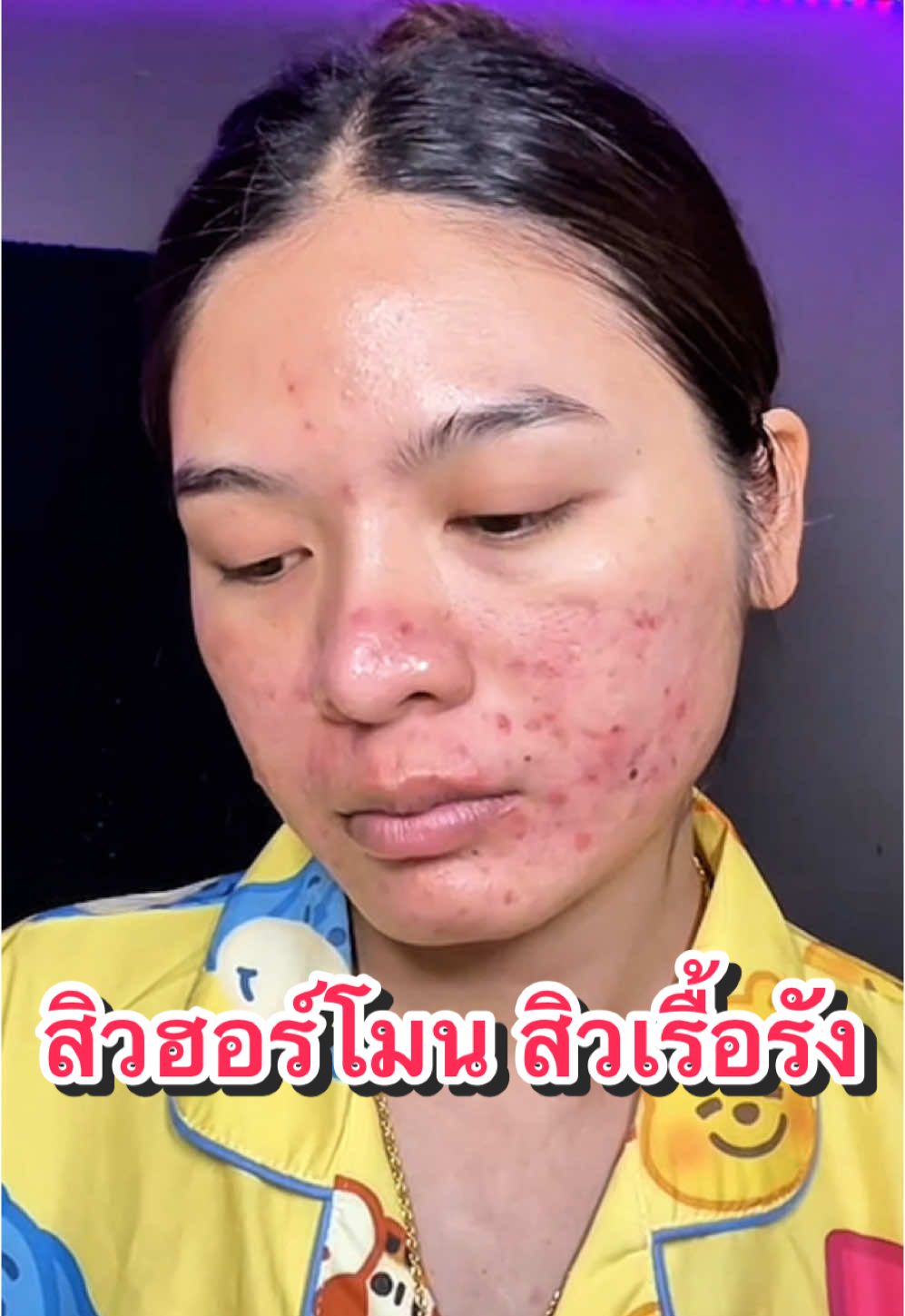 สิวฮอร์โมน สิวเรื้อรัง บอกเลย #กลูต้าส้มเลือด  เอาอยู่ #SWPTHAILAND 