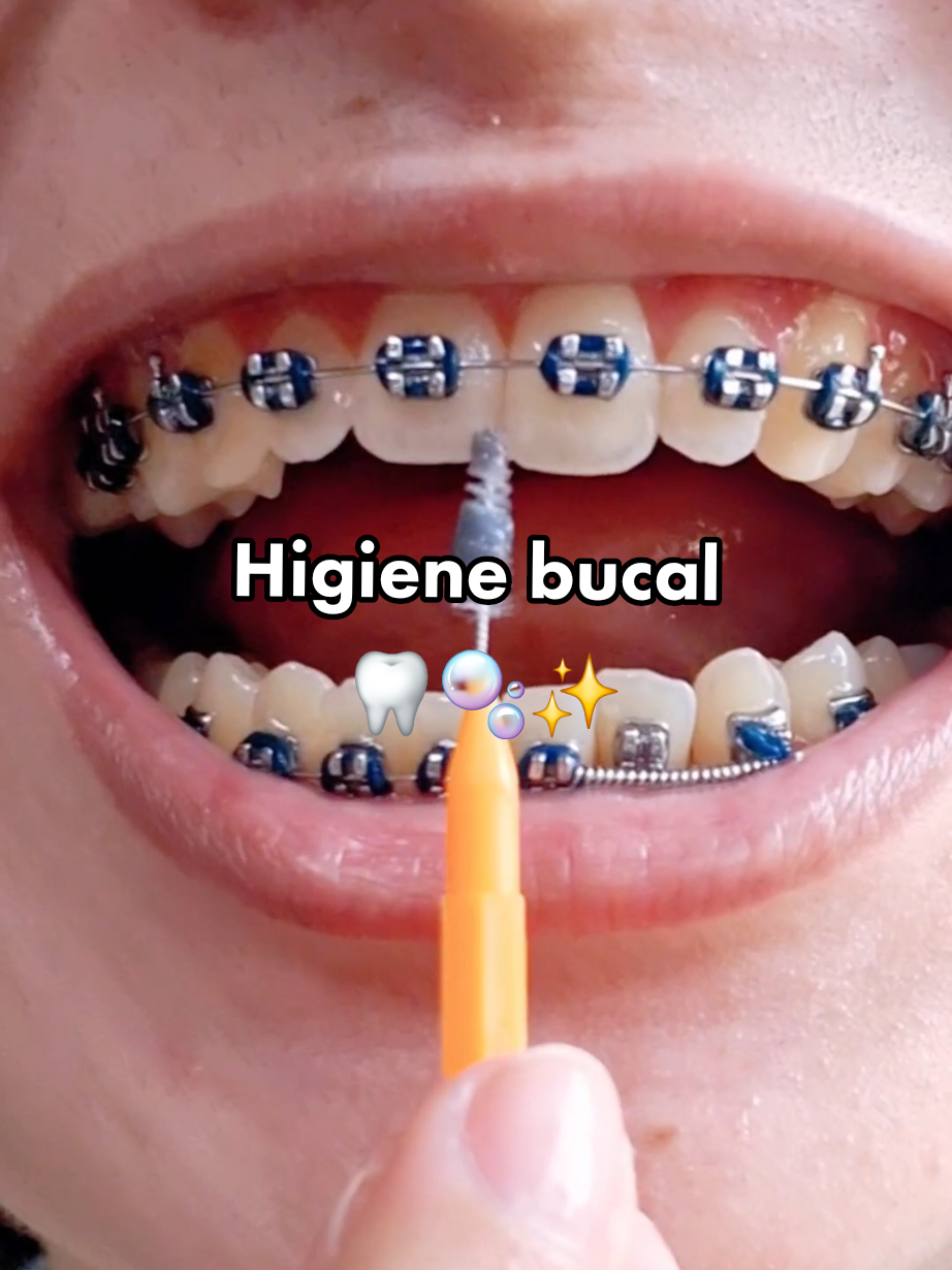 Limpeza do aparelho com escova interdental e rapador de língua 😛🦷✨ #dentist #aparelhoortodontico #dental #fouryou #fouryourpage #viral_video 