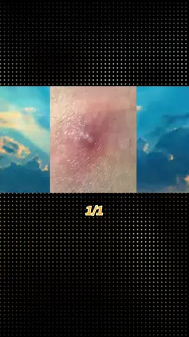 #squeeze #squeezeyuk #pimple #pimplepop #blackhead #acne #satisfying #treatment
