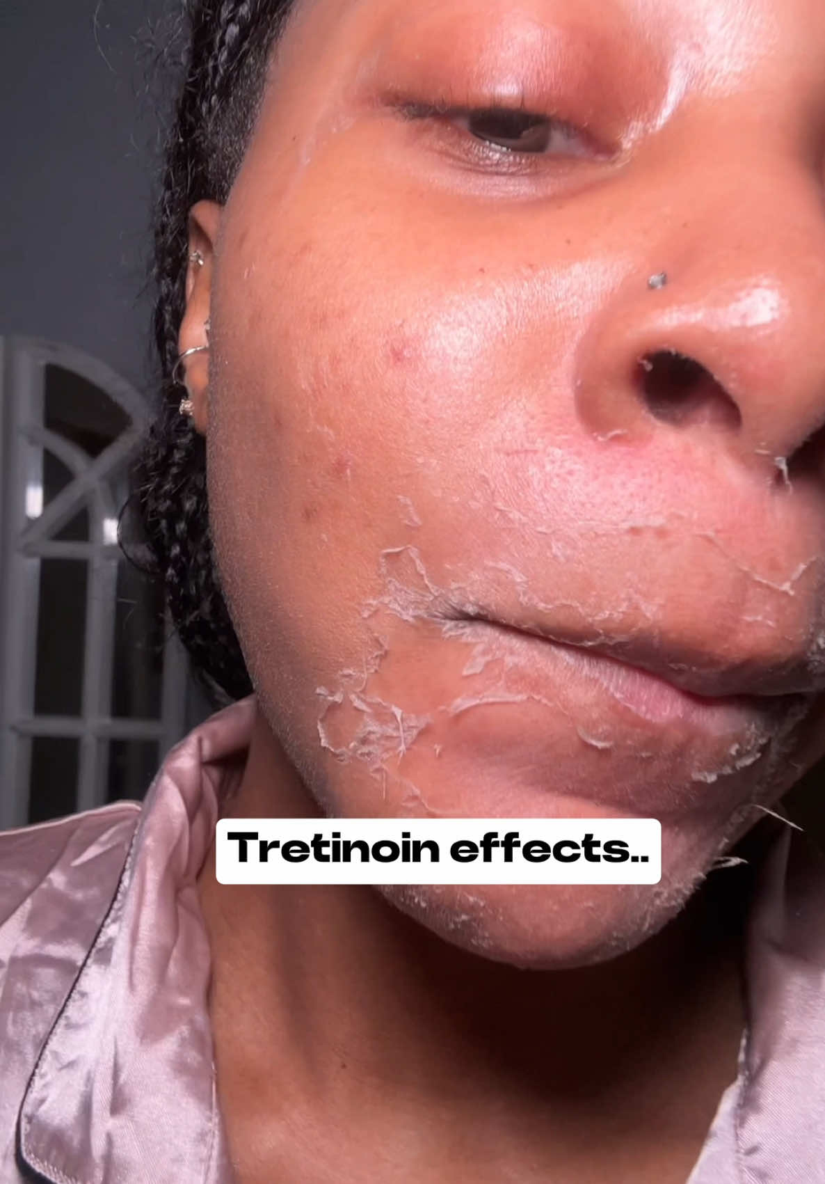 Love hate relationship with miss Tretinoin 😭💕 #tretinoin #tretinoinpurge #tretinoinjourney #skincare 