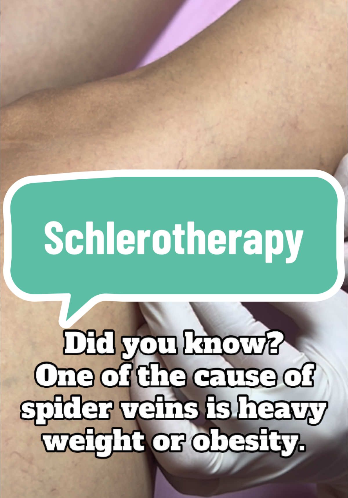 Yes, obesity can cause spider veins because it puts extra pressure on the veins in your legs. This pressure can weaken the vein walls and valves, causing blood to pool and bulge.  𝔹𝕆𝕆𝕂 𝕐𝕆𝕌ℝ 𝕊𝔼𝕊𝕊𝕀𝕆ℕ𝕊 ℕ𝕆𝕎! 𝙾𝚞𝚛 𝚕𝚘𝚌𝚊𝚝𝚒𝚘𝚗𝚜:                      TAGUIG BRANCH 𝙲𝚊𝚕𝚕 𝚞𝚜: ☎️ (+632) 7001 0302 📍𝙲𝚘𝚛𝚗𝚎𝚛 81 𝙶𝚎𝚗. 𝙻𝚞𝚗𝚊 𝚂𝚝. 𝙱𝚛𝚐𝚢. 𝚄𝚜𝚞𝚜𝚊𝚗 𝙰𝚕𝚘𝚗𝚐 𝙻𝚎𝚟𝚒 𝙼𝚊𝚛𝚒𝚊𝚗𝚘 𝙰𝚟𝚎 𝚃𝚊𝚐𝚞𝚒𝚐 𝙲𝚒𝚝𝚢.                                                                                                     📍 IMUS BRANCH  𝙲𝚊𝚕𝚕 𝚞𝚜: ☎️ (+046) 454 8469 📍Lot 1 E3 Patio Tirona St. Brgy. Anabu 2F (front of Pink Paradise apartelle) Imus City Cavite #schlerotherapy #varicoseveins #treatment #spiderveins #aesthetic #flawless #legs #fyp #tiktokph #tiktokphilippines #tiktokphilippines🇵🇭 