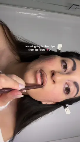 ty to the girlies on tiktok for showing me how cause i was freaking out!!! 🥶 #lipfillers #bruise  #makeuphack 