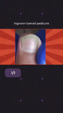 ingrown toenail pedicure #toenail #toenails #nail #nails #pedicure #unhaencravada #callus #ingrowntoenail #satisfying #fyp