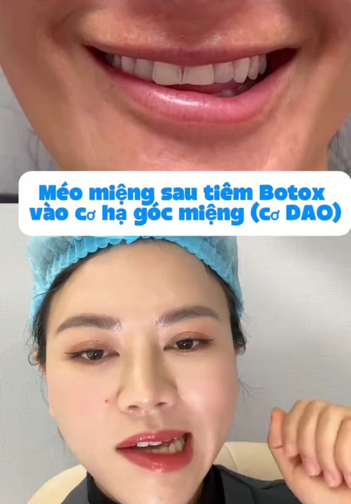 Lệch méo miệng sau tiêm botox #bstranoanh #drtranoanh #tiembotox #botoxin 