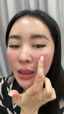 Da cấy meso xong dùng như này nha mấy ní #Lanabeauty #thuylanduongda #ampoul #meso