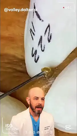 Theres some meat on this pore of winer! #dermatology #satisfying - #doctor #react #skincare #squeezeyuk #acne #pimple #pimplepop #blackhead #satisfying #foryoupage #foryou  #تنظيف_بشره  #whiteheads #رؤوس_سوداء #عنايه_بالبشره #دهون 