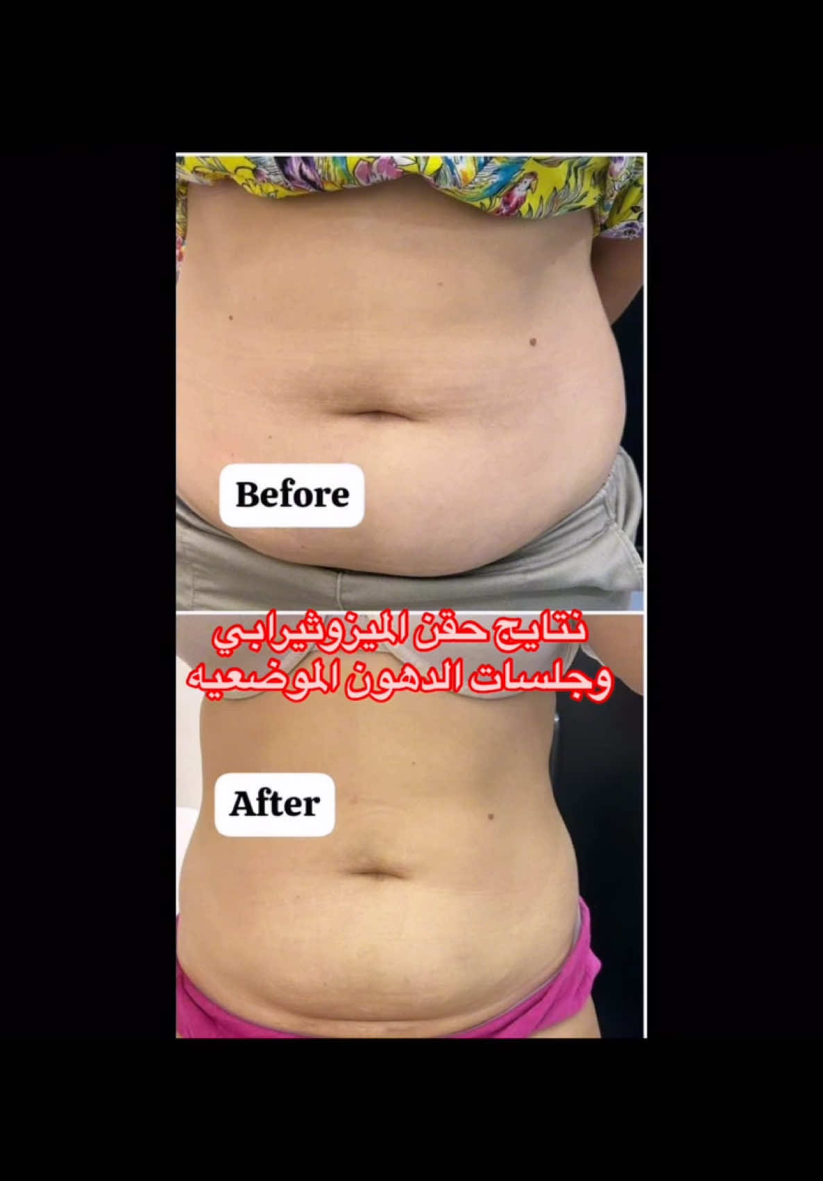 حقن تفتيت الدهون مناسبه لاي منطقه مديقانا 💉 بجلسات قليله هتقدري تغيري شكل جسمك للاحلي 😍 للحجز اكتبي كومنت او ابعتي رساله وهيتم الرد . . . #دهون_البطن #تكسير_الدهون #نحت_الجسم #تخسيس_الوزن #ميزوثيرابي 