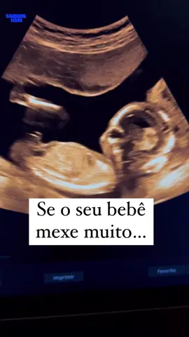 As vezes o bebê mexe tanto que a mãe fica preocupada 😅 Mas fique tranquila se você tem um bebê cheio de energia aí na sua barriga 🤰🏻  A movimentação fetal é um importante parâmetro pra avaliar risco de sofrimento fetal ou redução do líquido amniótico, pois se o bebê fica sem espaço dentro da barriga ele vai mexer menos.  Então, se o seu bebê não para de chutar e se movimentar é porque ele está bem nutrido, com a vitalidade preservada e com espaço suficiente !  Agora me conta aqui 👇🏻 se o seu bebê é mais quietinho ou é mais animado 😜 💁🏻‍♀️  @draamandagrangeiro  #saudedamulher  #saudedagestante  #prenatal  #exameslaboratoriais  #examesdesangue  #gravidez #gestacao #maedeprimeiraviagem  #ultrassom #3d/4d   #morfologica  #gemeosultrassom #gemeos #gemelar  #gravidezgemelar