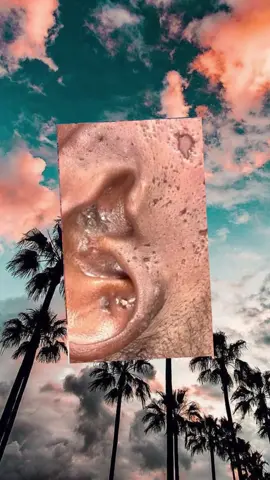 #squeeze #acneskincare #pimples #pimple #pimplepop #blackhead #satisfyingvideo #fyp 