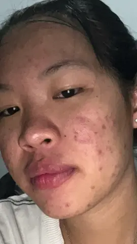 โคนแต้มสิว#ผิวติดสาร #สิวอุดตัน #สิวฮอร์โมน #แต้มสิว #รักษาสิวด้วยตัวเอง #รักตัวเอง #สิวหาย 