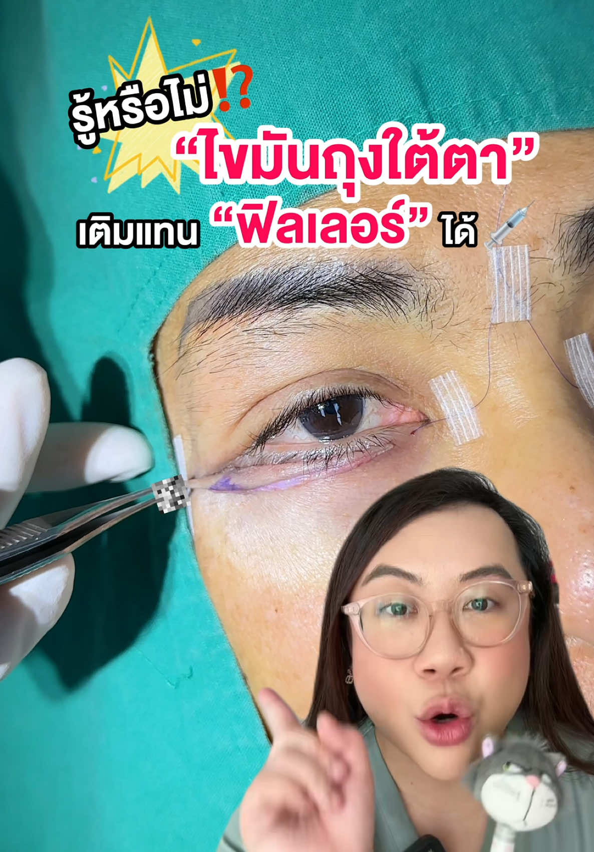 รู้หรือไม่⁉️ ไขมันถุงใต้ตาสามารถเติมแทนฟิลเลอร์ได้✨🤔 #ตัดถุงใต้ตา #ตัดไขมันถุงใต้ตา #ฟิลเลอร์  #รีวิวเฟิร์นคลินิก #หมอเฟิร์นfernclinic #รีวิวบิวตี้ 