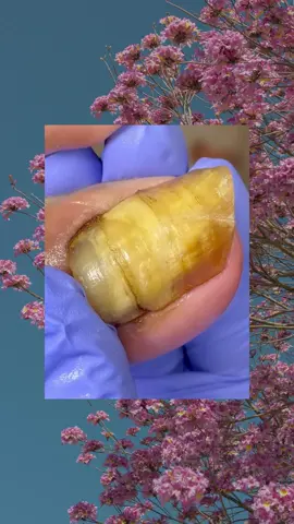 perfeito aqui 👏👍❤️‍🩹#ingrowntoenail #removal #satisfyingvideo #relaxing #toenail
