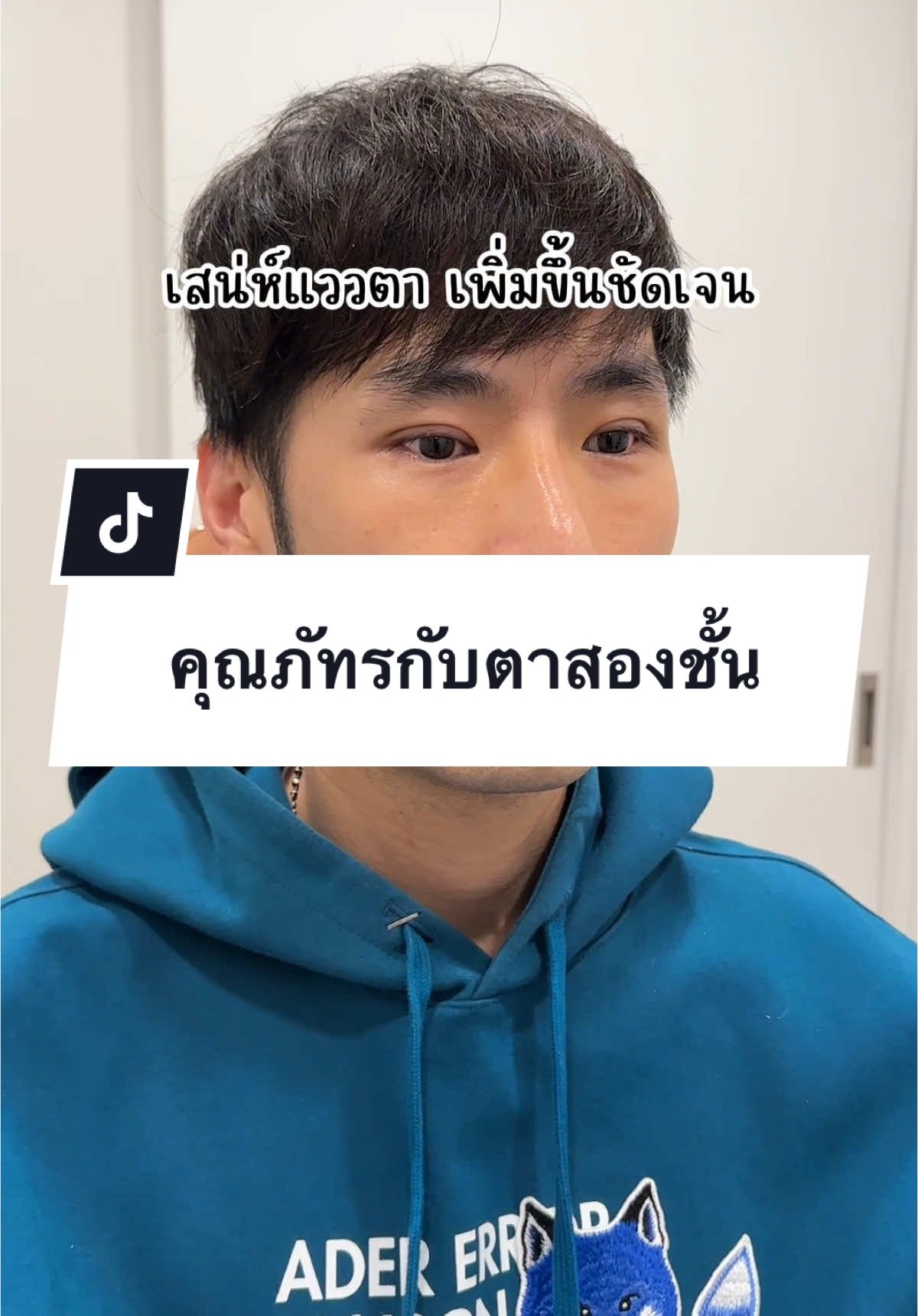 คุณภัทร ฉัตรบริรักษ์ กับการทำตาสองชั้นที่ทำให้เสน่ห์เพิ่มขึ้น 300% 😍✨ #โรงพยาบาลดีเอ #ศัลยกรรมเกาหลี #ศัลยกรรมเปลี่ยนชีวิต #ศัลยกรรม 