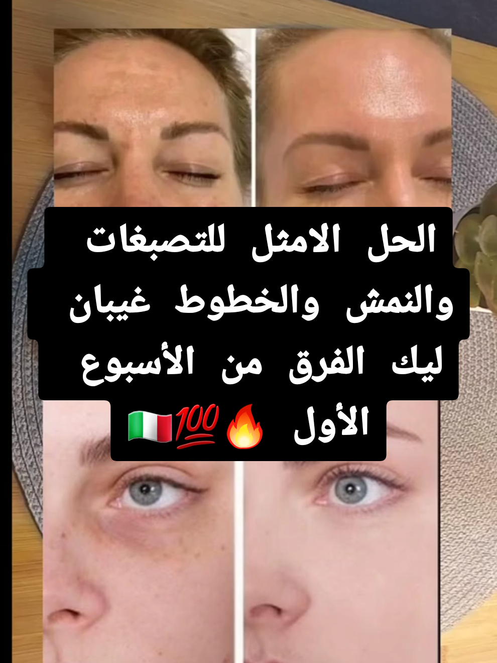 كريم بخلاصة هلام الحلزون قاهر التصبغات والبقع والنش وآثاره الحبوب وكذلك التجاعيد والخطوط #منتوجات_طبيعية #beauty #chogan #cosmetics #كريمات #التصبغات #النمش #التجاعيد #غسول #غسول_للوجه #فرنسا🇨🇵_بلجيكا🇧🇪_المانيا🇩🇪_اسبانيا🇪🇸 #اسبانيا🇪🇸_ايطاليا🇮🇹_البرتغال🇵🇹 #ايطاليا🇮🇹 #كريمات_تفتيح_البشرة_والجسم #كريم #منتجات #وصفات #المغرب #prufumo 