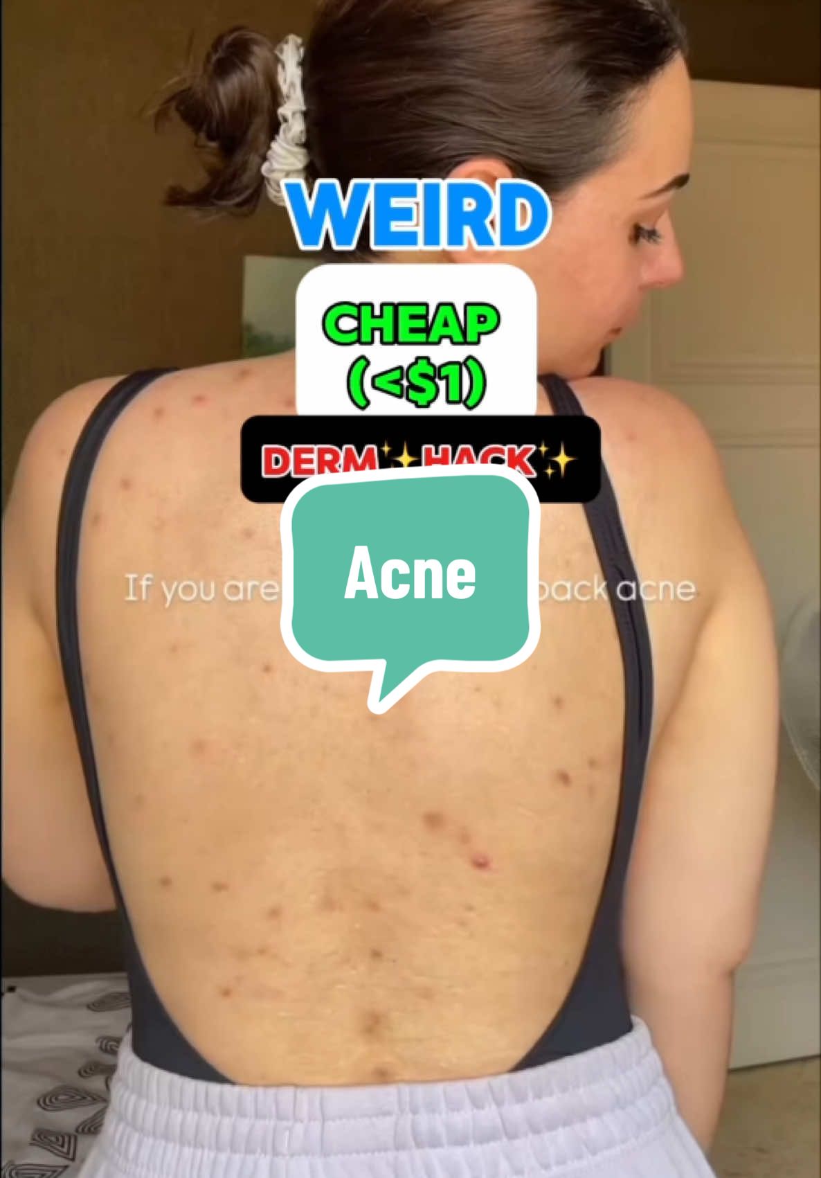 One of my favorite ways to help acne and eczema/sensitive skin…. Dilute bleach baths are incredibly effective for calming skin and decolonizing from bacteria.  In a full bath, add 1/2 cup regular (not extra strength) bleach.  Always check with your doc first before doing this.  And it’s super cheap! Like less than $0.50/bath 🤯 *Please note that this post (like all of social media) is meant to entertain and educate. Never take anything you see on social media as direct medical advice. Always chat with your personal doctor before acting on anything you see on social media. Remember, even otc products and supplements are medicine! Many of these topics are oversimplified to make them more digestible. Context is everything!  #Acne #Summer #darkspots #beauty #skincare #hack #doctor #dermatology