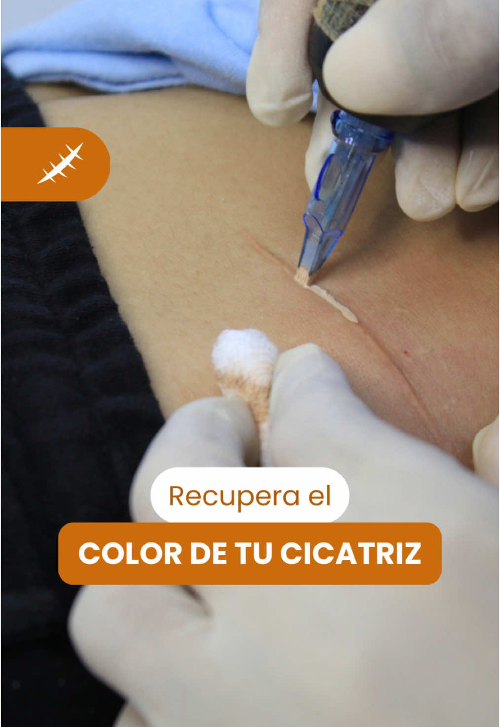 Si tienes una cicatriz blanca. Nanocamuflaje con Regenerislaser es tu tratamiento ideal ✨🤗 #tratamiento #cicatriz #cicatrices #cicatrizblanca #camouflage #camuflaje #camuflajedeestrias #camouflagetattoo #keloid #keloids #lima #limaperu 