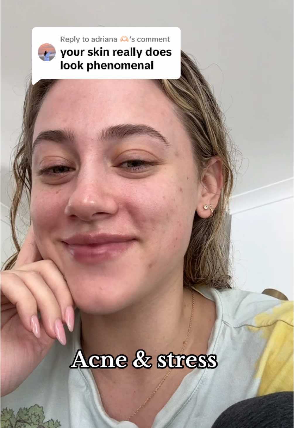 Replying to @adriana 🫶🏻 the wildfires in LA have been devastating and my thoughts are with everyone who is grieving and experiencing loss. This week has been unimaginable and horrifying.   I am thankfully evacuated and safe. And although it may seem strange to be thinking/talking about skin, skin-picking is one of the many manifestations of stress I experience, so if you are struggling mentally as a result of the fires, know you are not alone ❤️‍🩹🙏🏻 #skinpicking #ocd #acneproneskin 