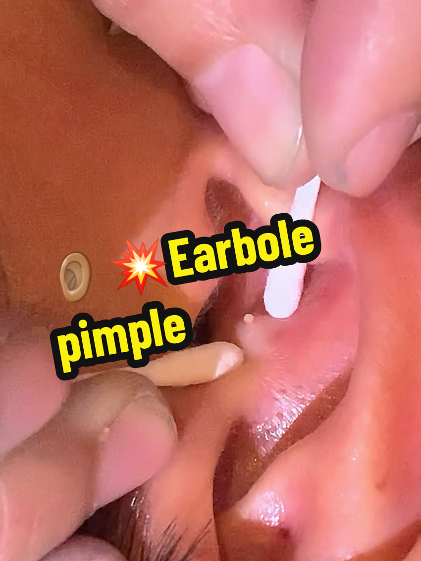 Earbole pimple popping #pimplepopper #pimples #pimple 