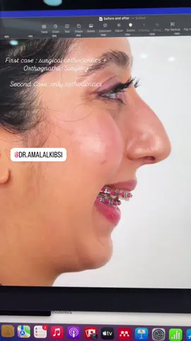 تغير ملامح الوجة بعد التقويم … جراحة او تقويم ؟      الحالة الاولى … تقويم جراحي و عملية جراحية للفكين و الذقن و الانف الحالة الثانية تقويم مع زرعات تقويمة فقط و كل حالة تختلف في نوع العلاج حسب صعوبتها#د_امل_الكبسي #افضل_عيادة_تقويم_اسنانانفزلاينd#dramalalkibsiق#قبل_وبعد_التقويمi#invisalignع#علاج_بروز_الأسنانا#ابتسامة_لثويةز#زرعات_تقويميةt#tadk#ksaf#fillerb#botoxج#جراحة_الوجه_والفكينب#بدون_عمليات_تجميلا#استشاري_تقويما#الخبرا#الدمام_الخبرا#الرياضت#تقويم_الاسنان_الحديثتقويم_الاسنان_المعاصر #ابتسامة_لثوية 