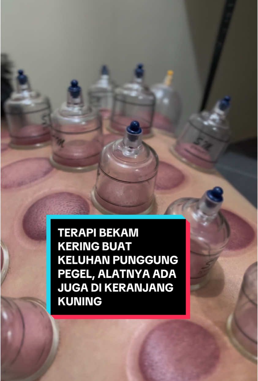 Mana yang lagi pada ngalamin kayak gini? Mending segera terapi. Oh ya, yang mau alatnya juga bisa cek di keranjang kuning, ya. Alatnya kuat dan tahan/awet. #bekam #drycupping #pijatjogja #fyp 