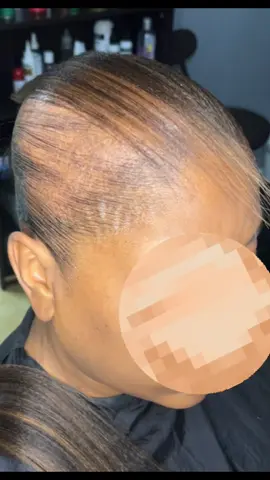 #alopecia #sleekponytail #hair #ponytailtutorial #ponytail #simplehairstyle #quickhairstyle #toryae 