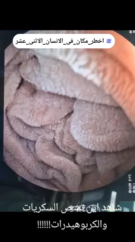 #الصندوق_الاسود_الجهاز_الهضمى_الامعاء_الدقيه 