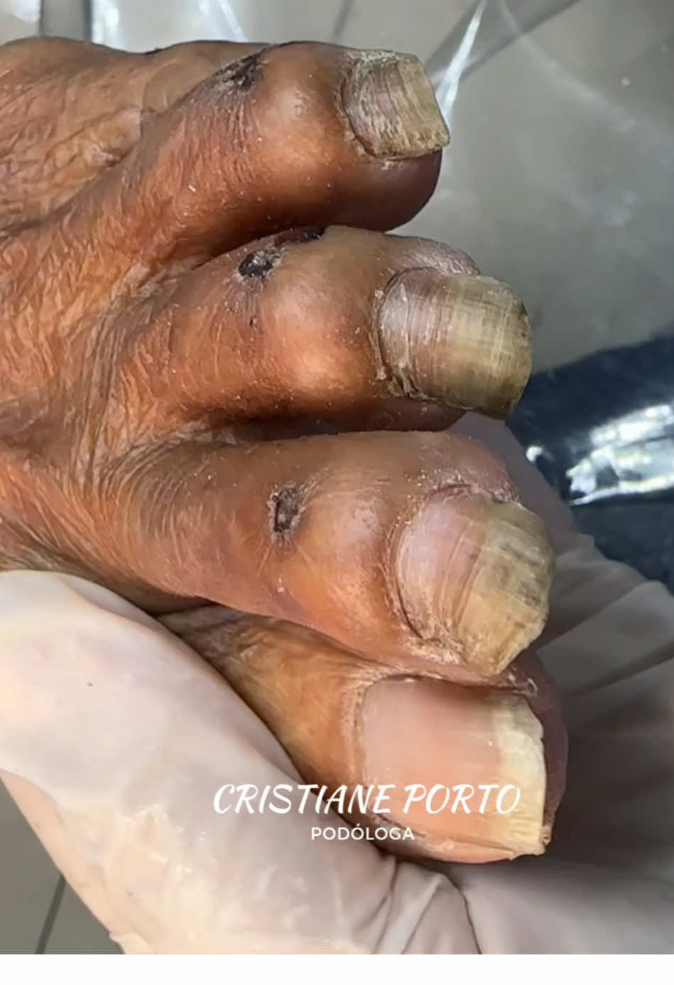 😱| (PARTE 2) 1 ANO SEM CORTAS UNHAS ! VEJA COMO FICOU  . #podologia #magé #satisfatório #nails #fypp #surreal 