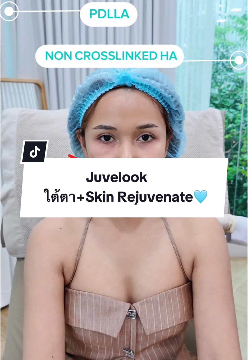 Juvelook.🩵 #คลินิกหมอใบเตย #sureenanclinic #คลินิกเสริมความงาม #หาดใหญ่ #juvelook #ริ้วรอยใต้ตา #ผิวดีชีวิตดี 👩🏻‍⚕️🇰🇷