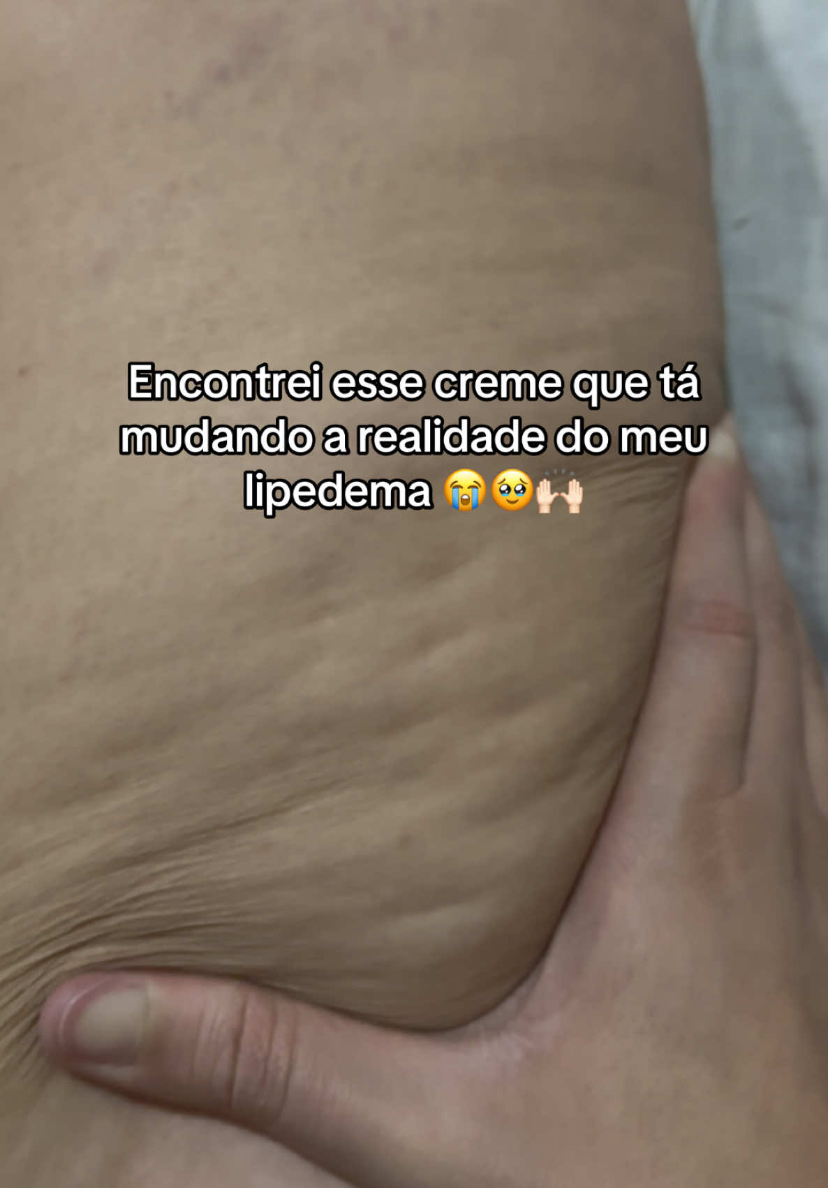É perfeito isso gente!!! #lipedema #flacidez #foliculite 