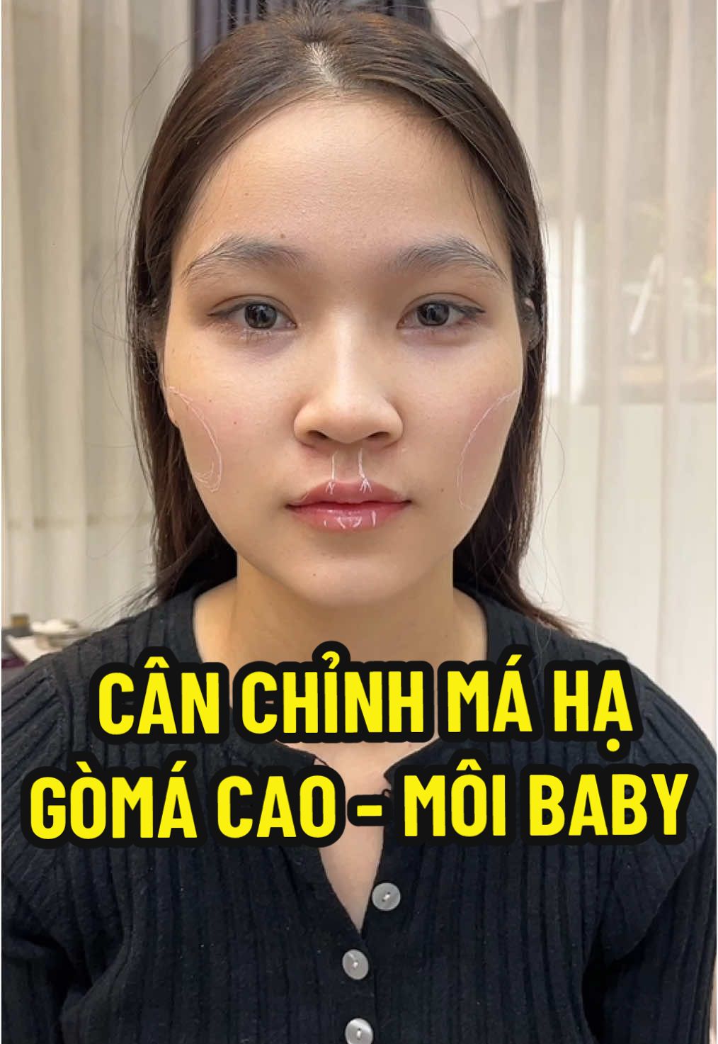 Mỗi bên má 1CC - môi 1CC mà thay đổi cỡ này 💓 #nganfiller #tiemmoi #mábaby #tiemma #xuhuong 