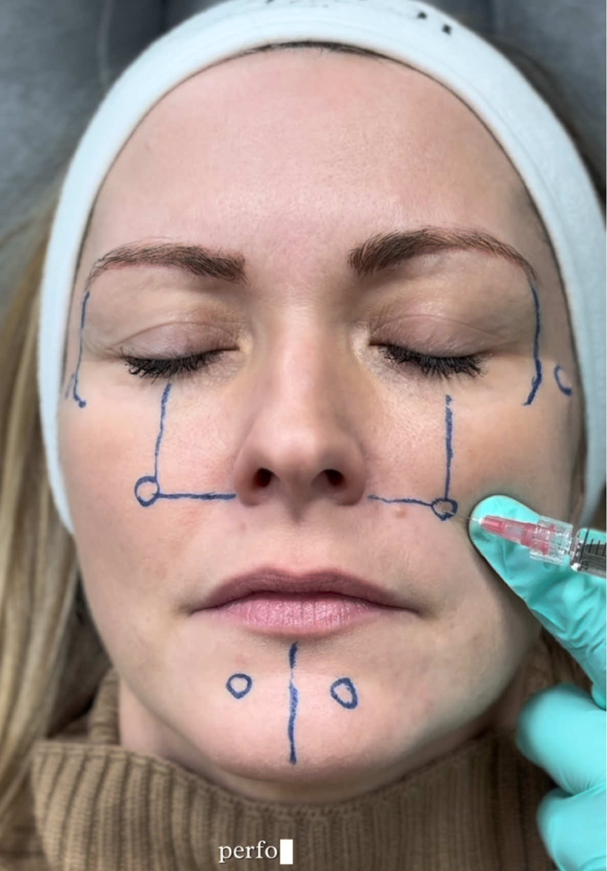 ❗️Profhilo treatment 🫣 SAVE MY TECHNIQUE FOR LATER! #profhilo  Injecting Profhilo from @ha_dermauk I  carefully mark the key points-mid-pupillary line, alar cartilage, and lower tragal line. With gentle precision, he inject small 0.2mL doses into the subdermal layer, ensuring each spot creates a slight lift to help the product spread 🙌🏼 The whole process takes just a few minutes, and you’ll start to see smoother, more hydrated skin in about 2 weeks! Have you ever had Profhilo before? 👇 Do you have any questions? Please let me know in the comments below ❤️ #injections #profhilo #cosmeticdoctor #skinrejuvenation #injectables 