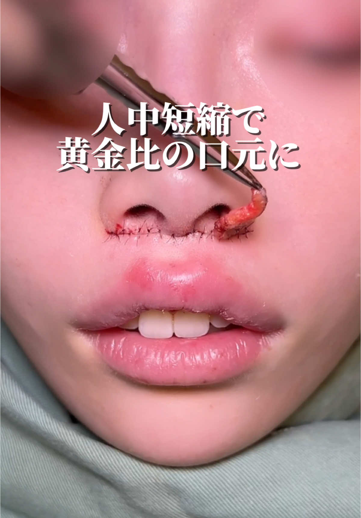 #人中短縮 #ヒアルロン酸 #唇 #唇ヒアルロン酸 #唇ヒアルロン酸 #lip #lipfiller #liplift #中顔面短縮 