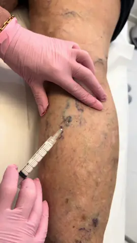 Tratamento moderno de varizes #clinicadrahelenpessoni #foryou #varizessemcirurgia #varicoseveins #varizes #angiologista #fyp #viral #varizesgrossas 