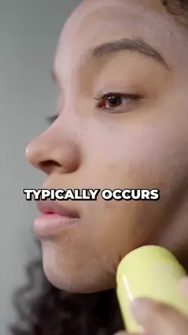 Let's Talk Hormonal Acne . One of the most common types of acne I see is hormonal acne, often showing up along the jawline and flaring around your cycle. For deeper, cystic breakouts, oral spironolactone is one of my go-to treatments-it reduces androgen production, calms oil, and prevents breakouts. . Have you dealt with hormonal acne? Let me know below! . . . . . . . #HormonalAcne #ClearSkinJourney #AcneTips #Spironolactone #DermatologistAdvice #HealthySkin #manhattanbeachdermatology #dermatologist #drninadesai #dermtips #dermatologyrocks
