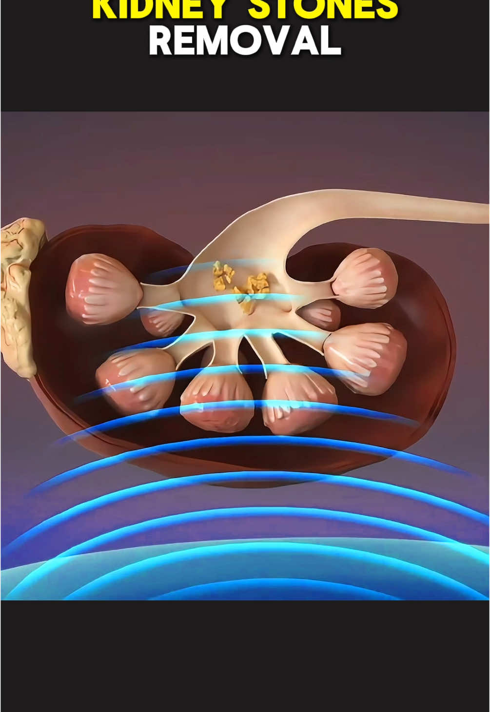 Shockwave Lithotripsy (3D Animation) | Kidney Stones Removal #shockwavelithotripsy #kidneystone #kidneystonesurgery #kidneystonesremoval #shockwavetherapy #medical3danimation #3dmedicalanimation #kidneystonetreatment #kidneystoneproblem 