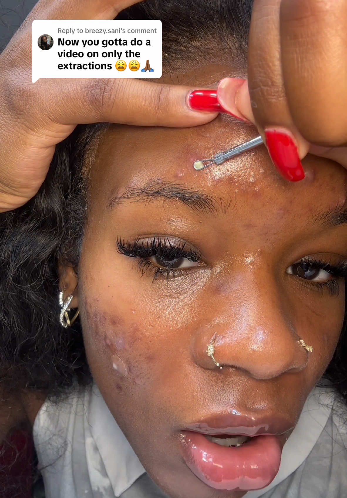 Replying to @breezy.sani u asked, you shall receive 🧘🏾‍♀️ #extractions #pimplepopping #satisfying #viral #acne #skintok  