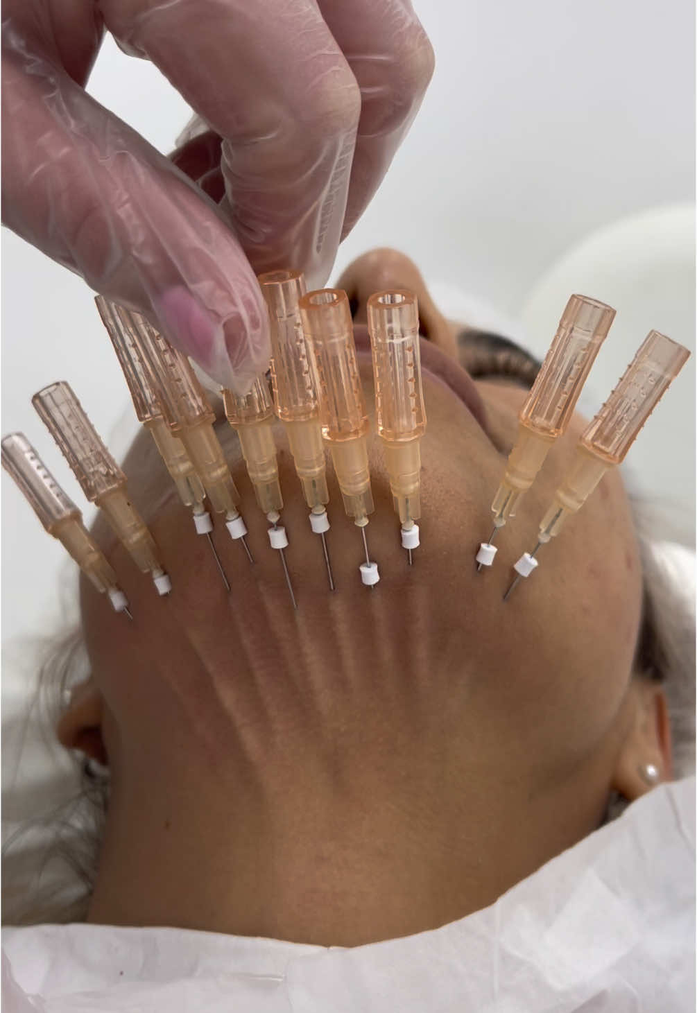 Skin tightening using PDO COLLAGEN THREADS 🧵  PDO thread lift treatment is most commonly used to help tighten sagging skin on the face, neck, and body without the need for invasive surgery. The cheeks, eyebrows, jawline, neck, nasolabial folds, marionette lines, arms, thighs and tummy can all be benefitted from PDO therapy. The PDO thread lift method stimulates collagen production in the skin, and after three months, collagen develops around the threads, creating a lifting effect that lasts between 12-18 months. #pdothreads #pdothreadlift #threadlift #facelift #threadsessex #brentwood #ffskin #cogthread #screwthread #facelift #lunchtimefacelift #10yearsyounger #cogthreads #nonsurgical #threadspecialist #collagen #youngerlookingskin #threadsbrentwood #brentwoodclinic #essexclinic #beautyessex #brentwoodbeauty