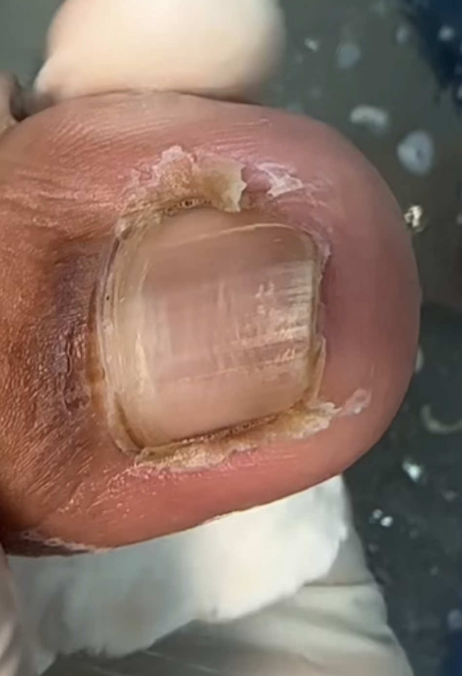 🤤| (PARTE 2) QUE VÍDEO MAIS SATISFATÓRIO  . #podologia #satisfatorio #magé #piabeta #fyppage #paravoce #peeling 