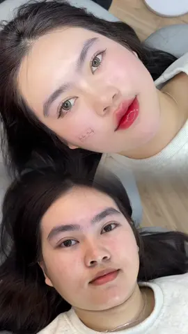 Thiếu chỗ nào ta bù vào chỗ đó😚.combo 3cc cho 3 vùng Môi+Cằm+Thái dương😚Như thay đầu luôn nha❤️