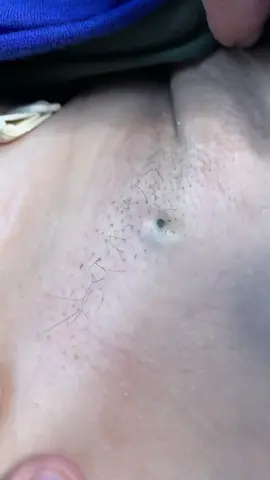 #puntosnegros #granosyespinillas #satisfactorio #granos #limpiezafacial